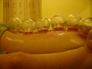 Cupping